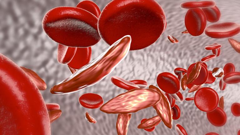 FDA approves two sickle cell disease gene therapies, one based on CRISPR